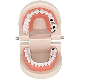 Easyinsmile Decay Tooth Model Dental Standard Teeth Teaching Model Denture Disease Teeth Model for Kids and Students Study